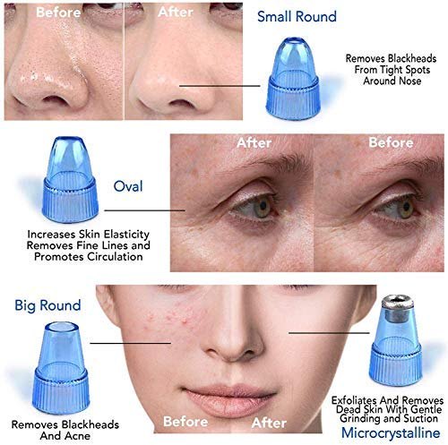 Derma Suction Blackhead Remover | Pimple Pore Cleaning Device