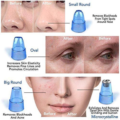 Derma Suction Blackhead Remover | Pimple Pore Cleaning Device
